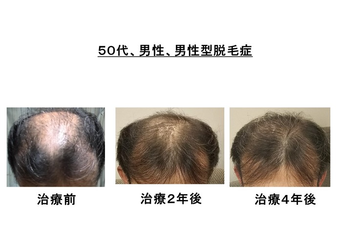 円形脱毛症　病院